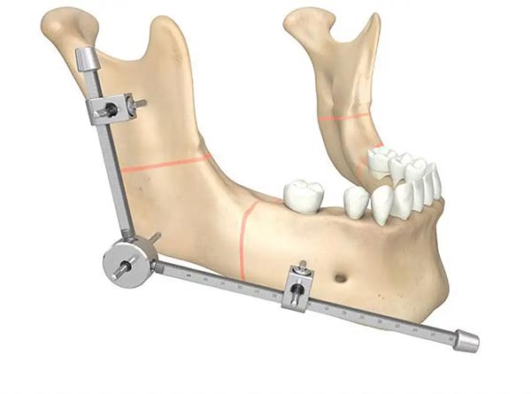 Distraction Osteogenesis