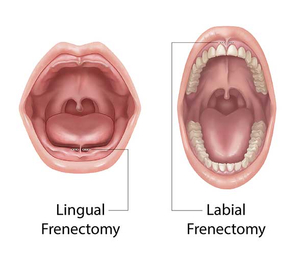 Types of Frenectomy