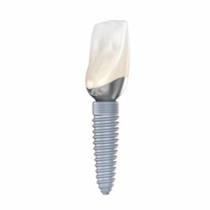 Image of a Dental Implant