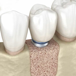 Graphic of an implant over bone grafting material