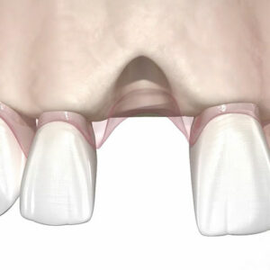Graphic of a jaw in need of bone grafting due to missing teeth