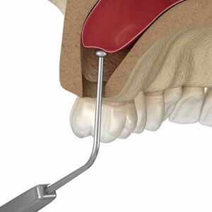 Graphic of a sinus lift procedure